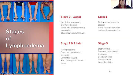 Lymphoedema & Exercise Oncology Summary
